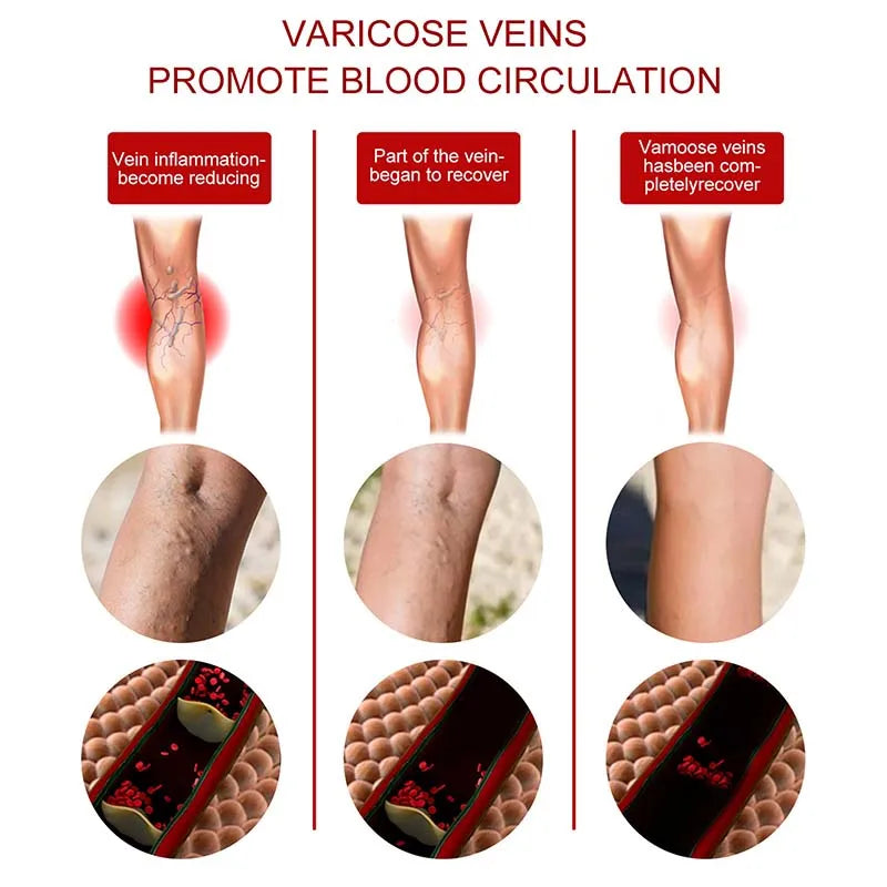 Seurico™ Varicose Veins Cream