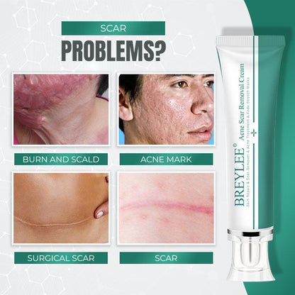 BREYLEE ™Skin Repair & Acne Scar Removal Cre am