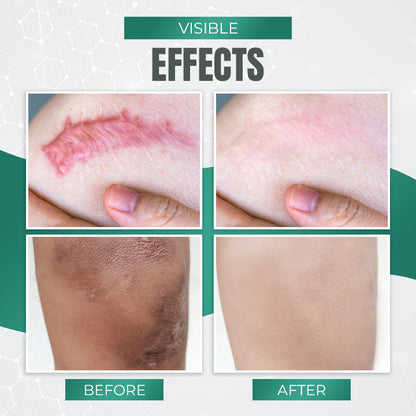 BREYLEE ™Skin Repair & Acne Scar Removal Cre am