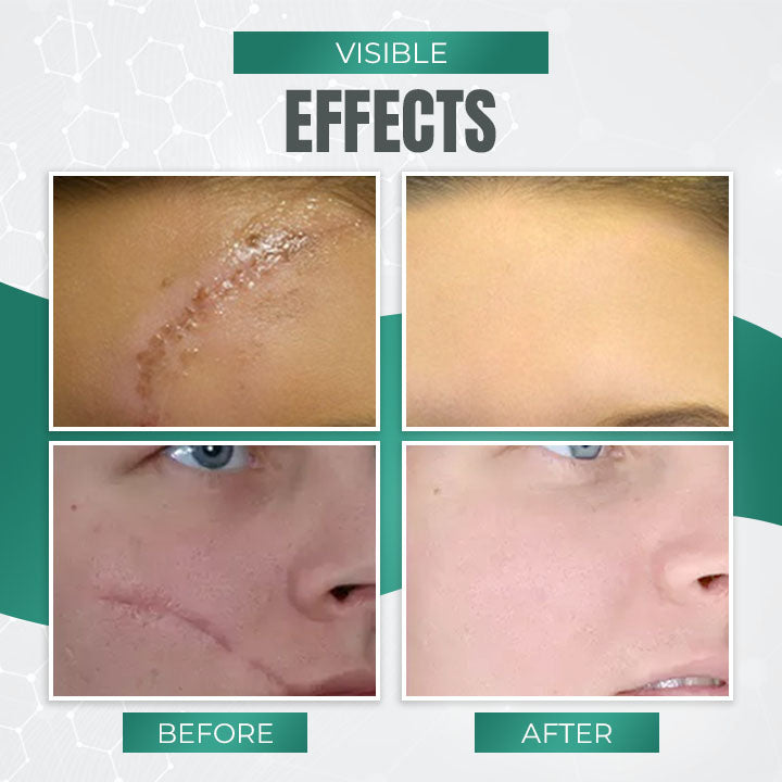 BREYLEE ™Skin Repair & Acne Scar Removal Cre am