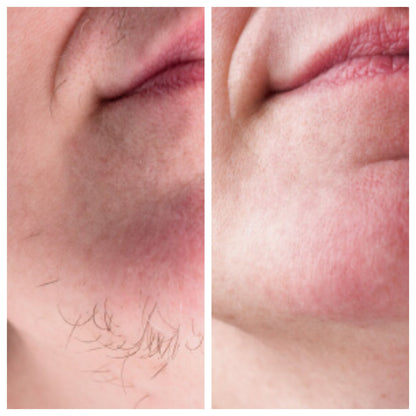 At-Home PCOS Facial Hair Natural Treatment