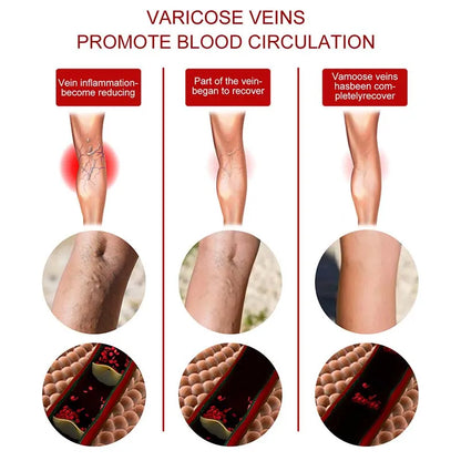 Seurico™ Varicose Veins Cream