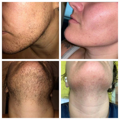 At-Home PCOS Facial Hair Natural Treatment