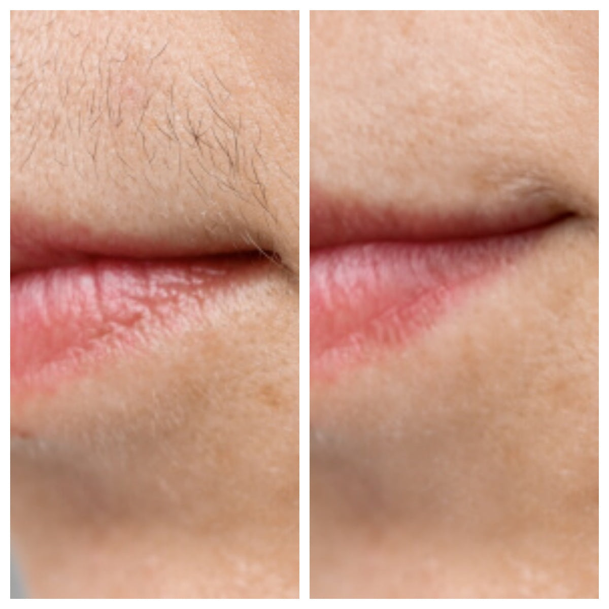 At-Home PCOS Facial Hair Natural Treatment